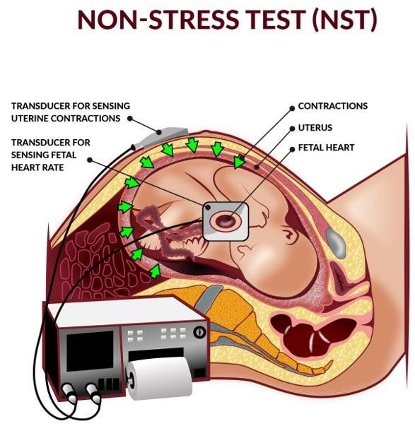 Non-stress test