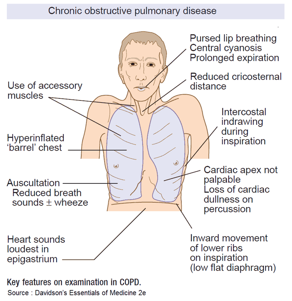 Full article: Factors Discriminating Spontaneous Pursed-Lips Breathing Use  in Patients with COPD